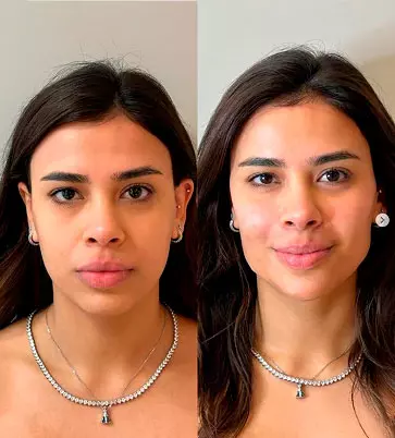 Antes e Depois