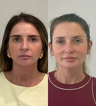 Antes e Depois