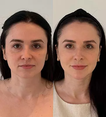 Antes e Depois